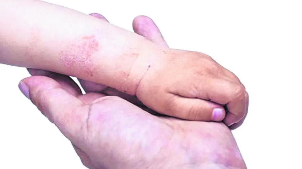 Dermatosis en lactancia materna