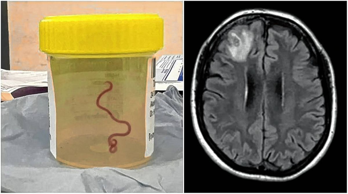 Científicos descubren por primera vez en el mundo un gusano parásito en el cerebro de una mujer