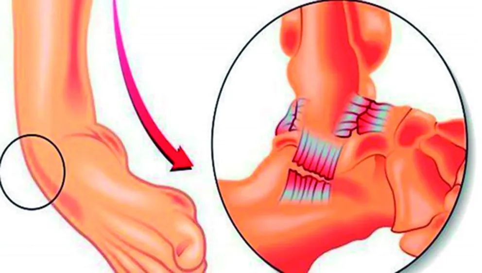 Esguince de tobillo de inestabilidad