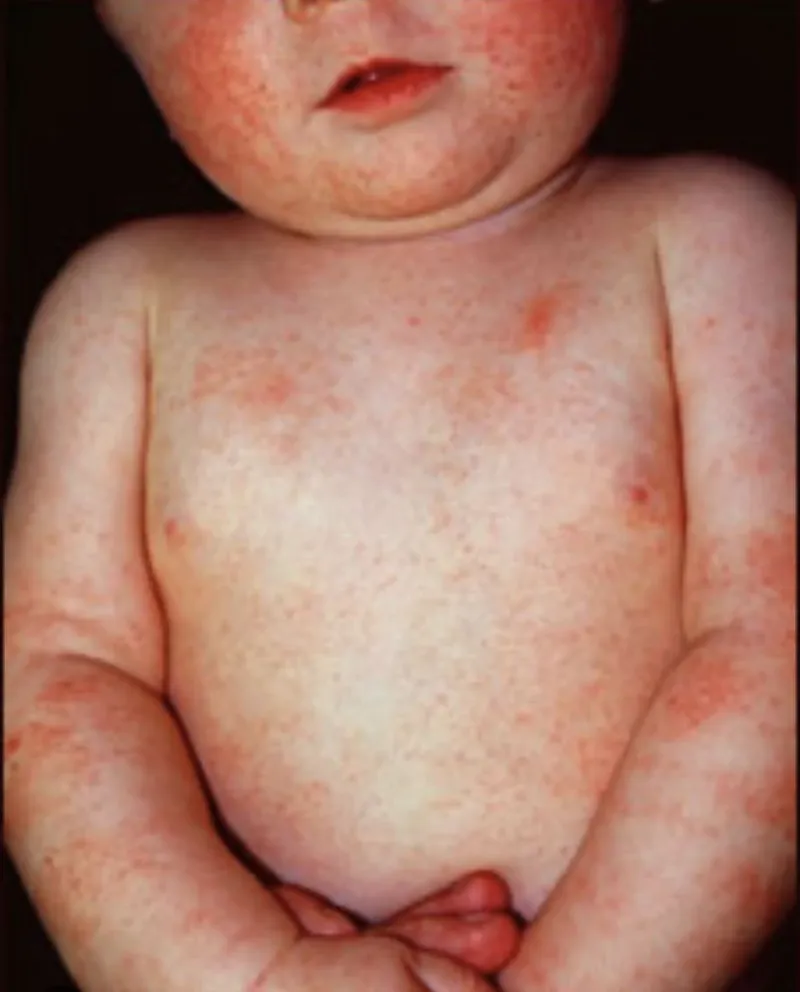 Dermatitis Atópica: Campaña de educación 