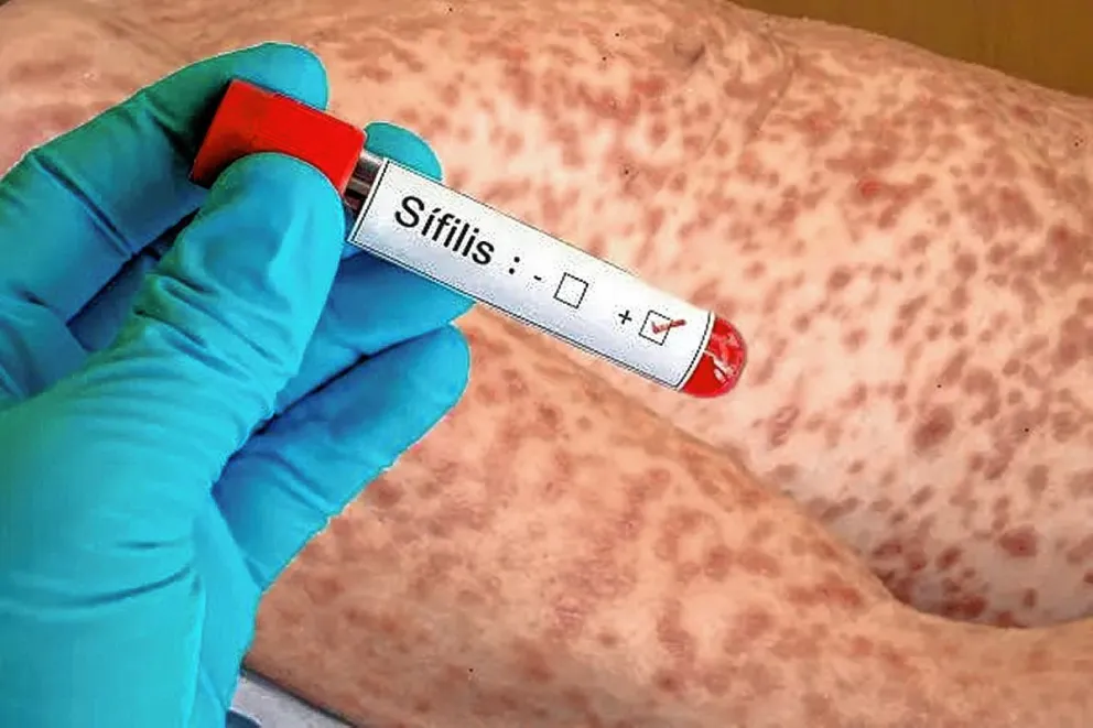 Preocupación en la provincia por el aumento de la cantidad de personas con sífilis: se triplicó en dos años