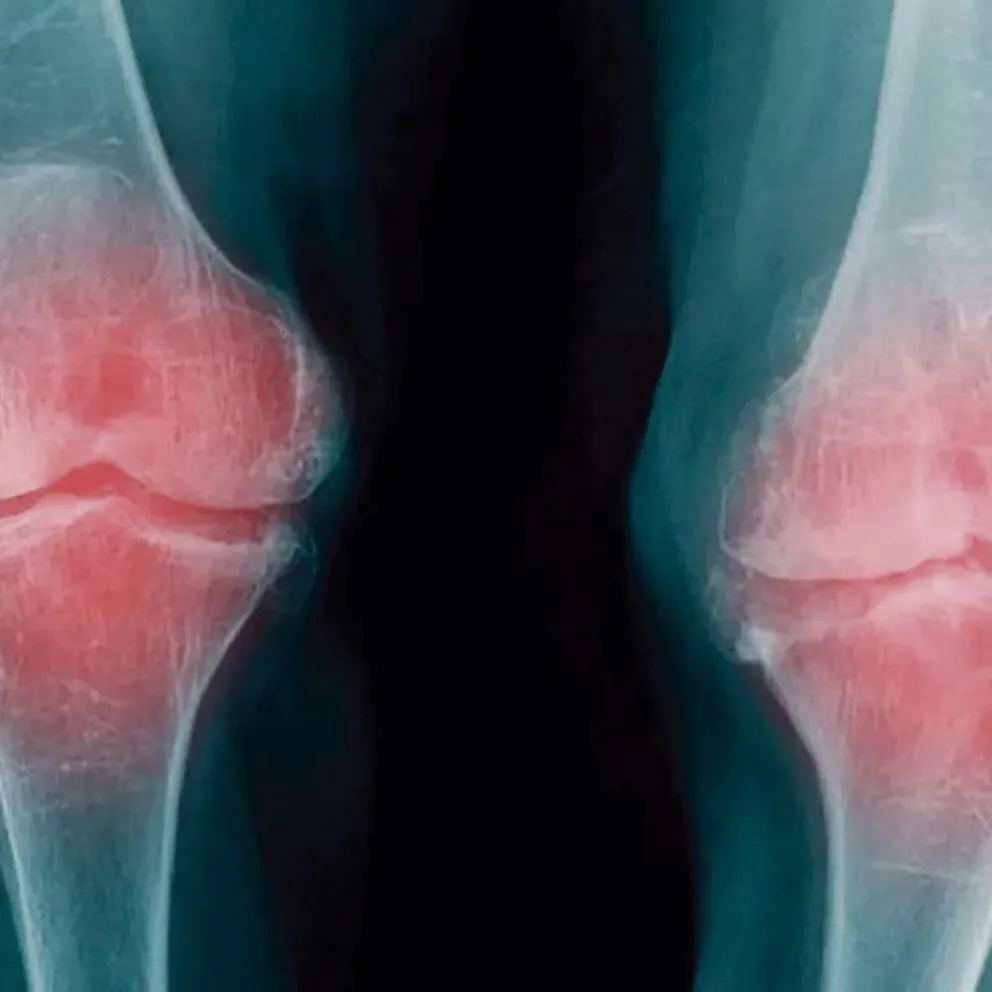 Doctor, tengo artrosis ¿Qué actividad puedo hacer?