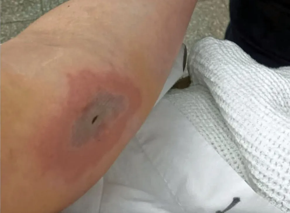 Una mujer fue a atenderse en el hospital de Río Gallegos y denunció que le colocaron formol en lugar de lidocaína