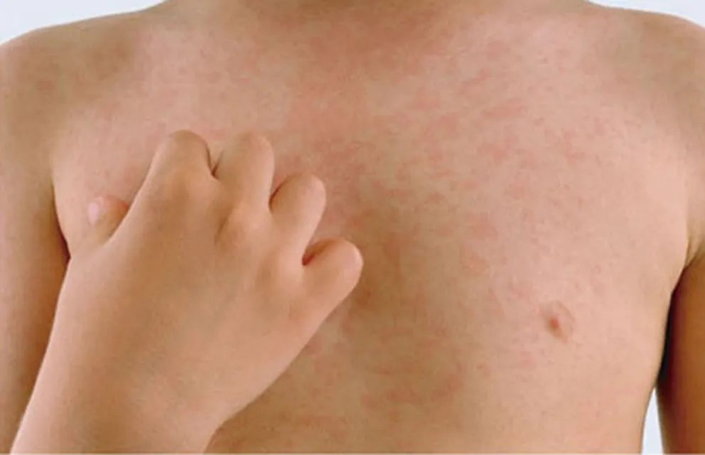 ¿Qué es la urticaria?