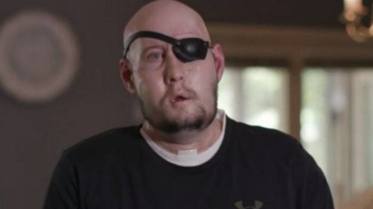 Un hombre recibió el primer trasplante de ojo completo en el mundo