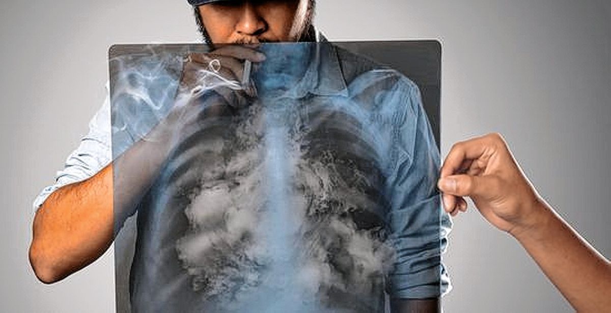 El cáncer de pulmón y dos grandes desafíos: reducir el impacto del cigarrillo y diagnosticar antes para ganarle la carrera al tumor