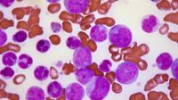 En Argentina, se diagnostican cerca de 1.200 nuevos casos de leucemia mieloide aguda por año