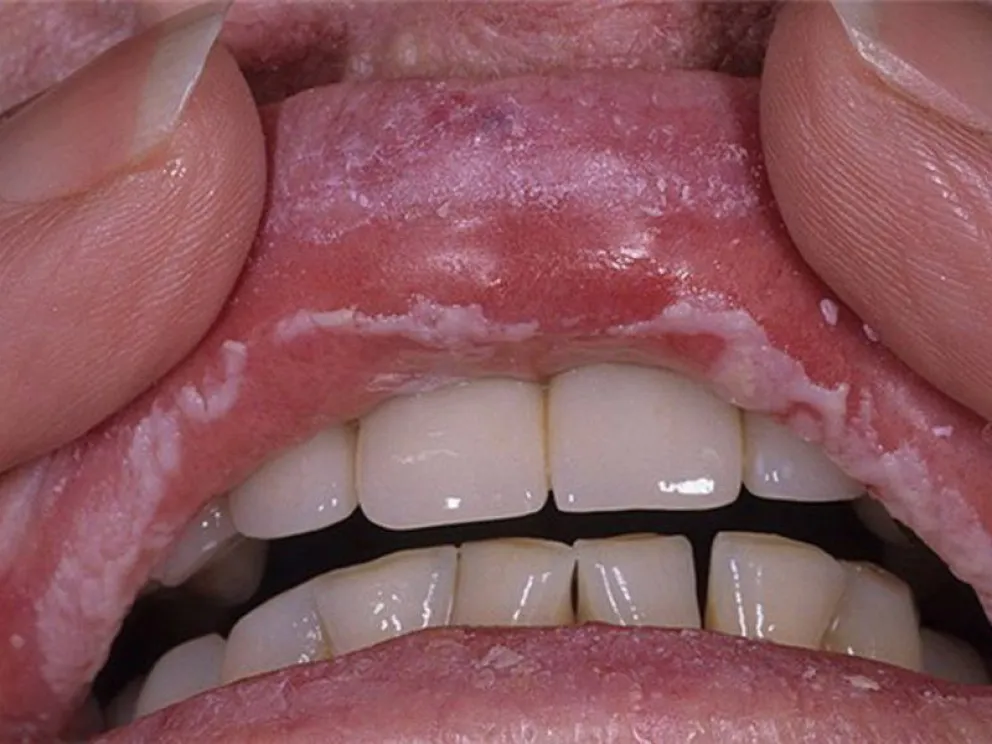 Candidiasis en la boca