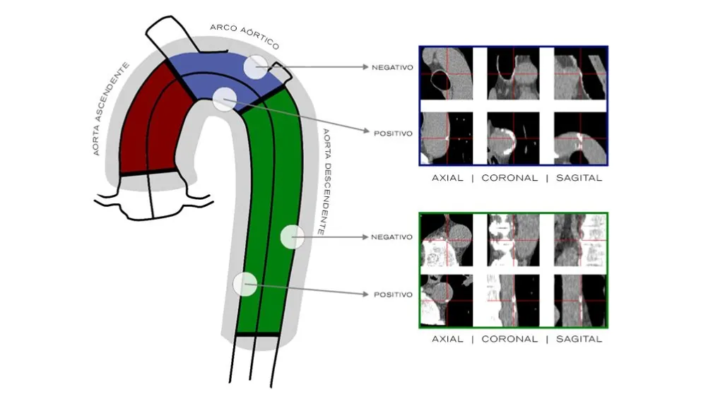 Desarrollan un sistema basado en IA que procesa tomografías del corazón