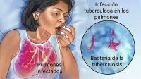Alerta epidemiológico en el Alvear y en el Regional por un caso de tuberculosis
