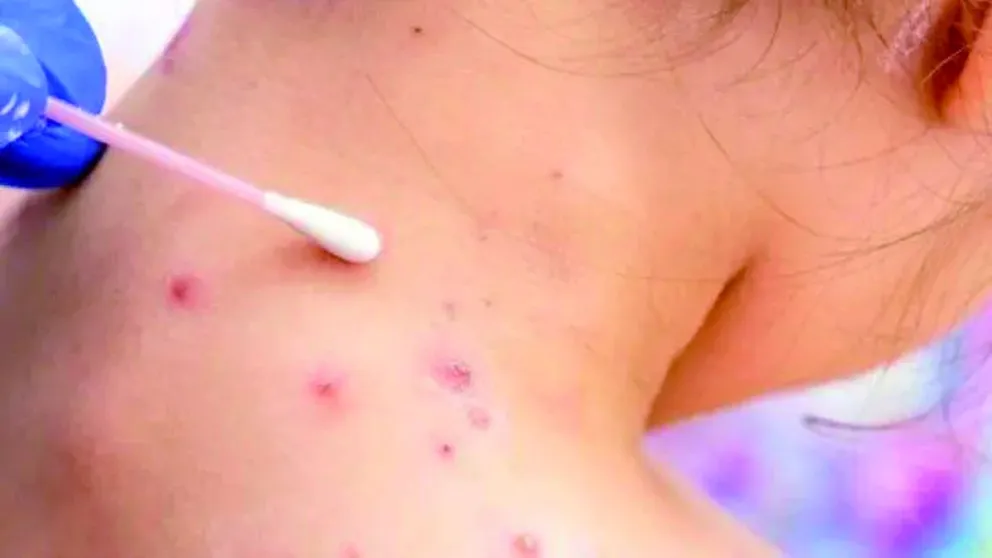 Viruela del mono en Argentina: ya se reportaron ocho casos en el país