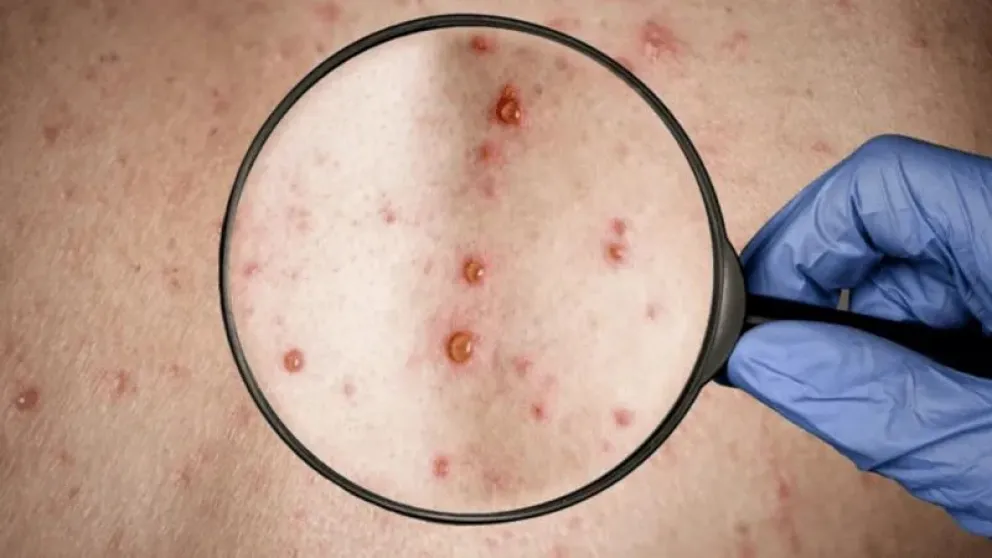 Cómo evitar el contagio de viruela del mono: medidas preventivas y detalles