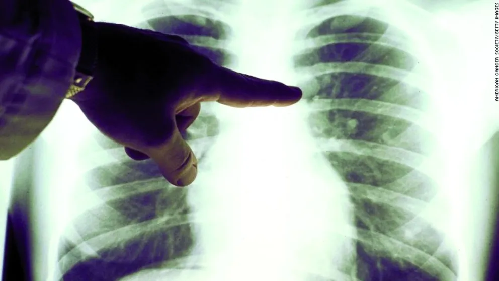Vacuna contra el cáncer de pulmón marca un hito en la medicina moderna