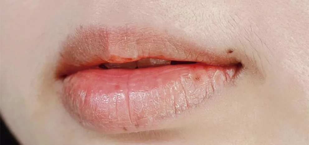 ¿Por qué se me seca la boca?