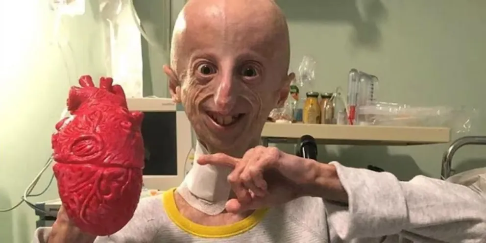 Murió Sammy Basso, el hombre con envejecimiento prematuro más longevo del mundo: tenía 28 años