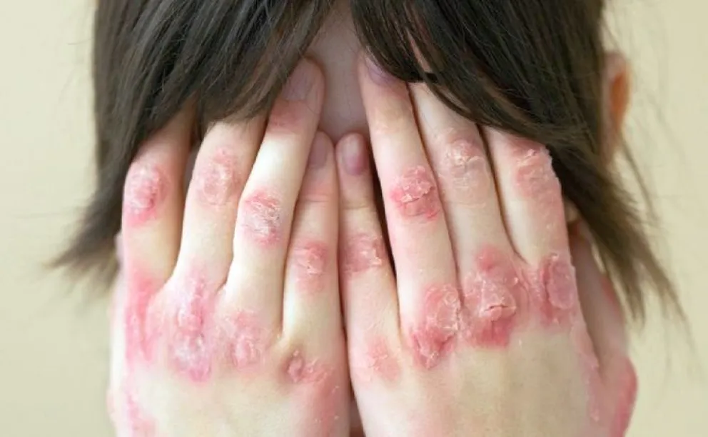 El 42% de los pacientes con psoriasis postergó o suspendió la consulta médica por motivos económicos