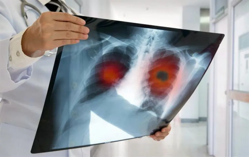 Biomarcadores en cáncer de pulmón: herramientas clave para determinar la mejor terapia dirigida según diagnóstico