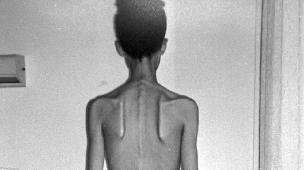 Prevención y tratamiento de los trastornos de la conducta alimentaria en jóvenes y adolescentes