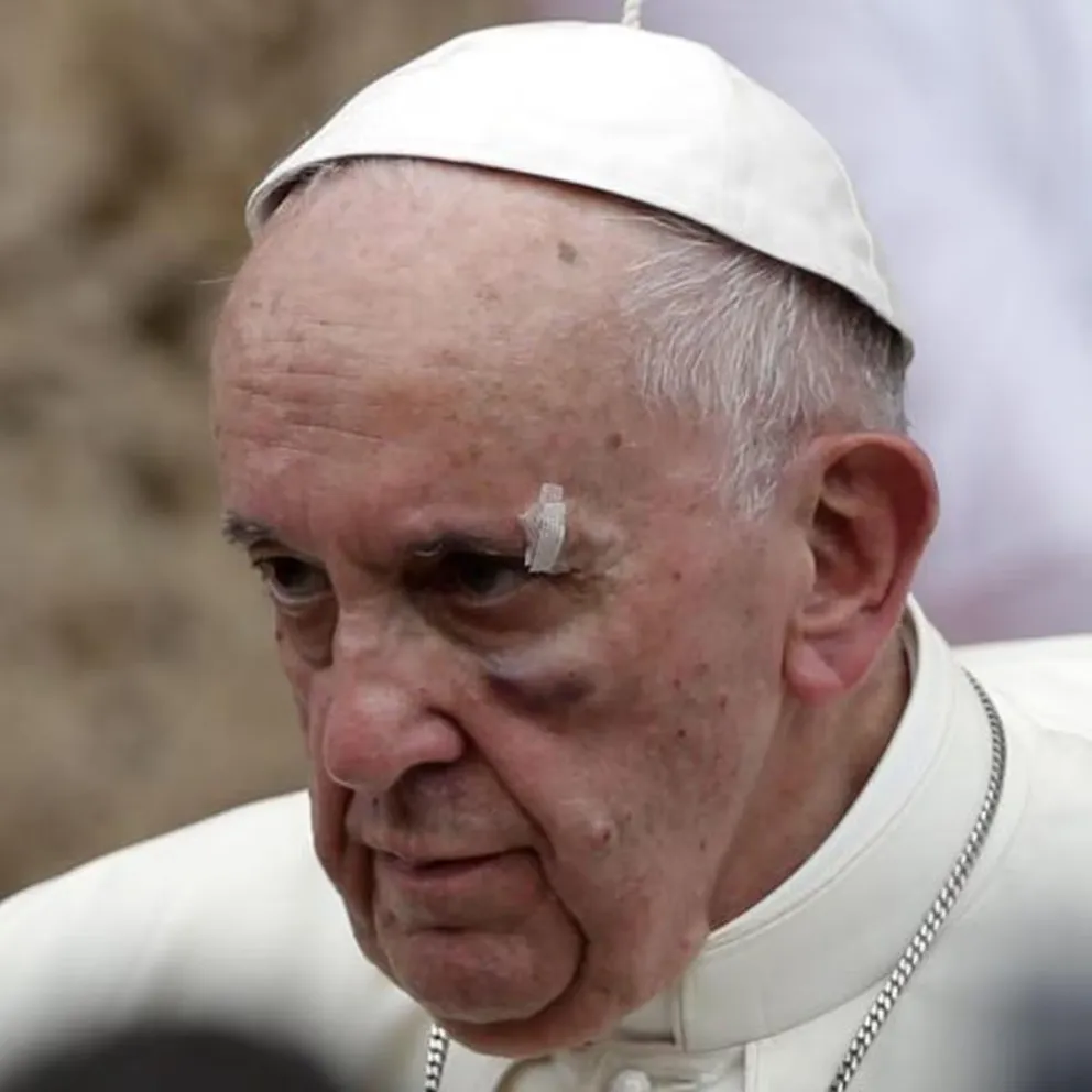 El Papa hinchado y con moretones en la cara después de una fuerte caída
