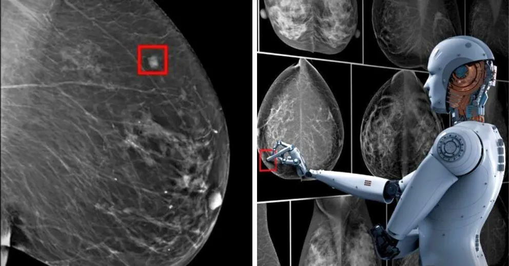 Inteligencia Artificial: Cómo se usa en la investigación del cáncer