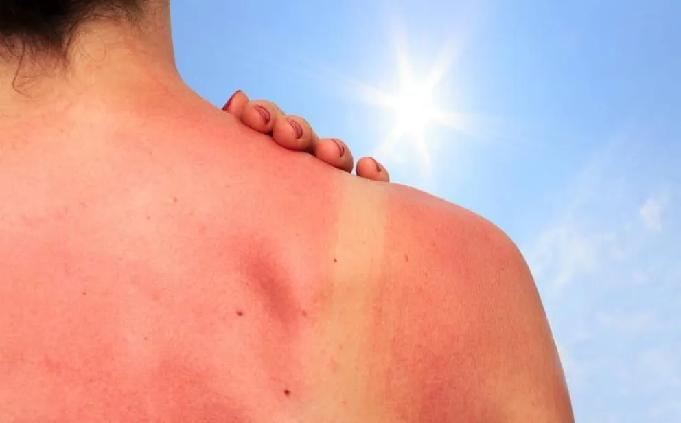 El cuidado de la piel frente a las altas temperaturas y la exposición solar