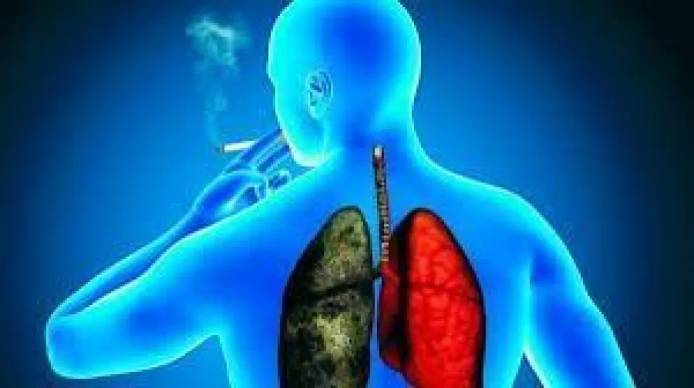 ¿Cómo determinar el mejor tratamiento para el cáncer de pulmón?