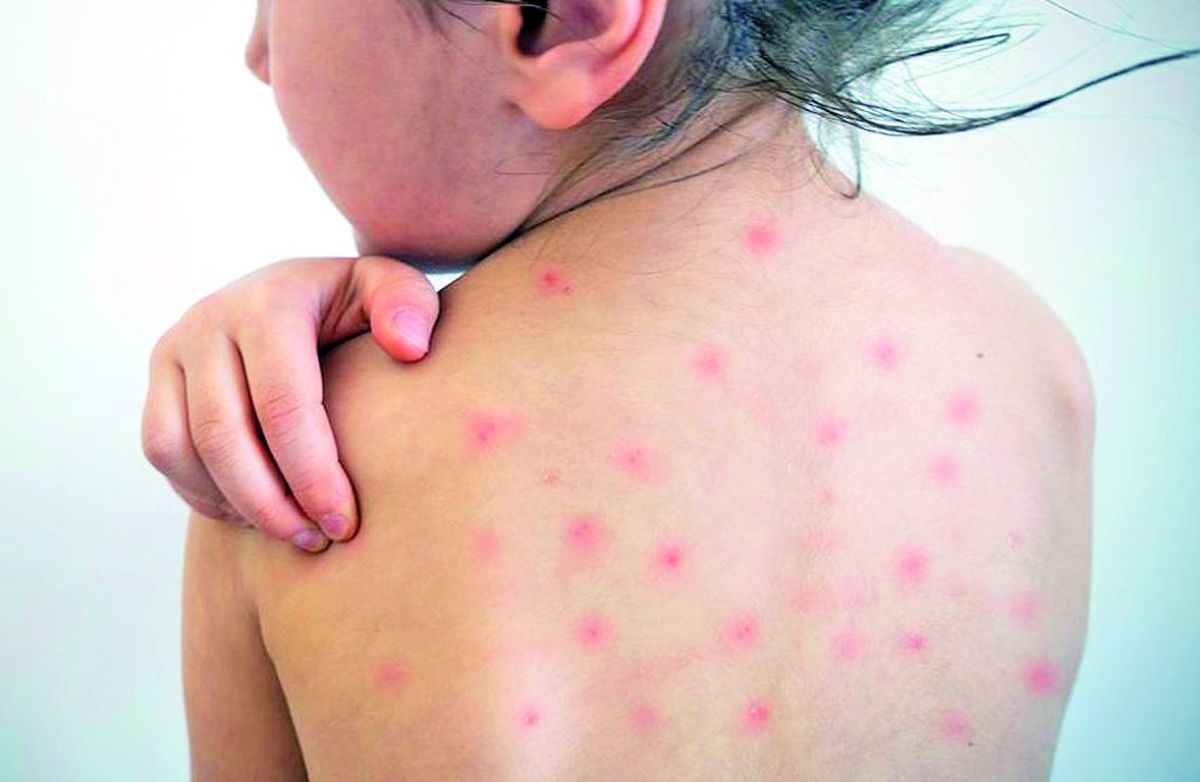 Preocupación sanitaria tras el alerta epidemiológico por casos de sarampión