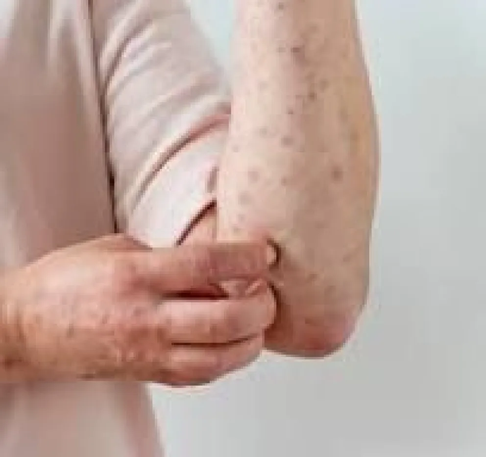 Qué es el sarampión y cómo prevenirlo