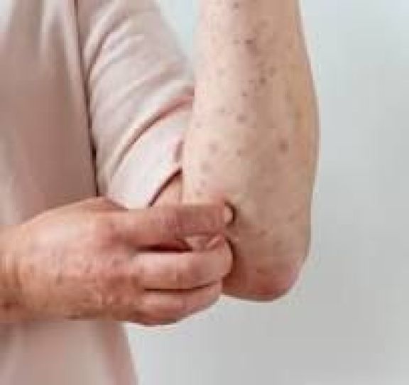 Qué es el sarampión y cómo prevenirlo