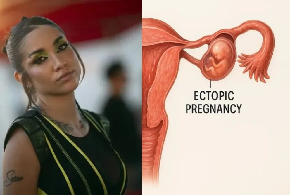 Qué es un embarazo ectópico, la complicación médica que casi le cuesta la vida a María Becerra