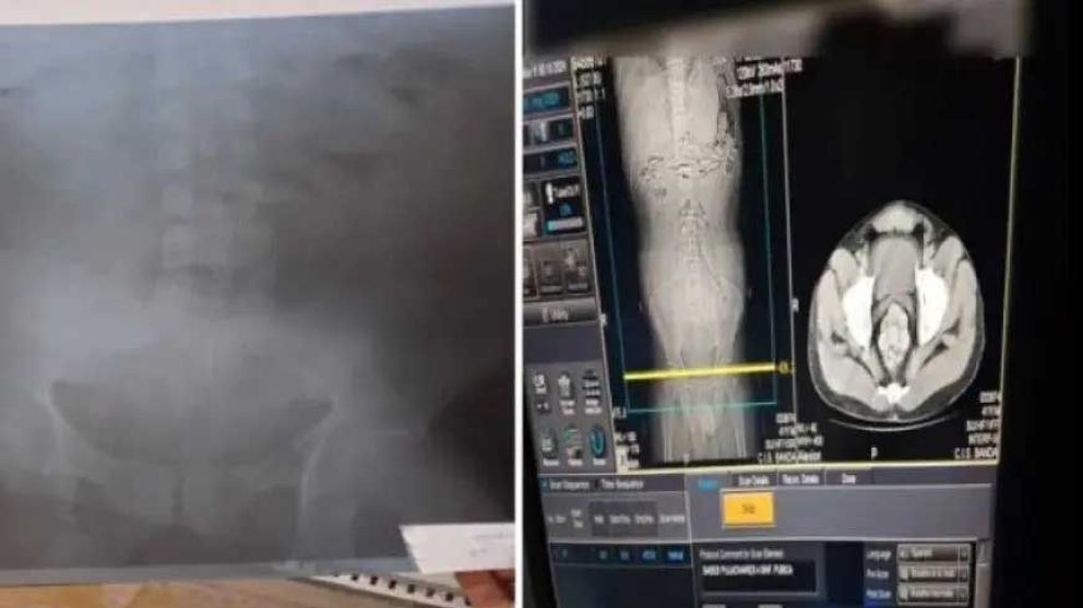 Detienen a un joven que llevaba cápsulas en el estómago y confesó ser una "mula"