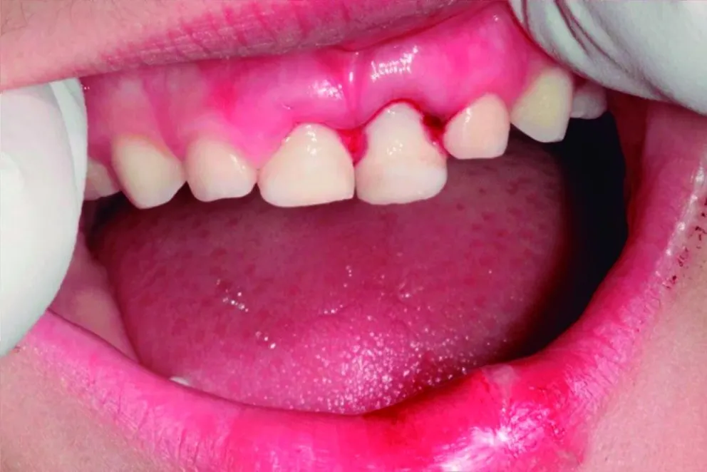Traumatismo dental en niños