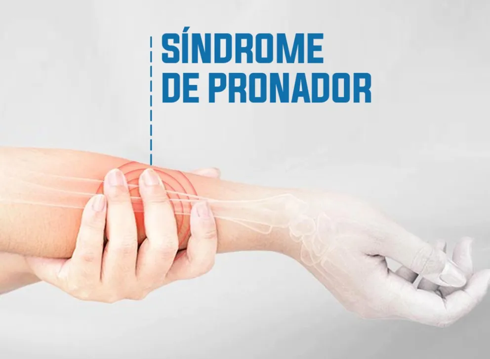 Síndrome del Pronador