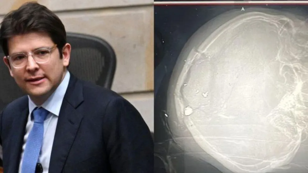 Colombia: Miguel Uribe continúa en estado crítico tras recibir un disparo en la cabeza