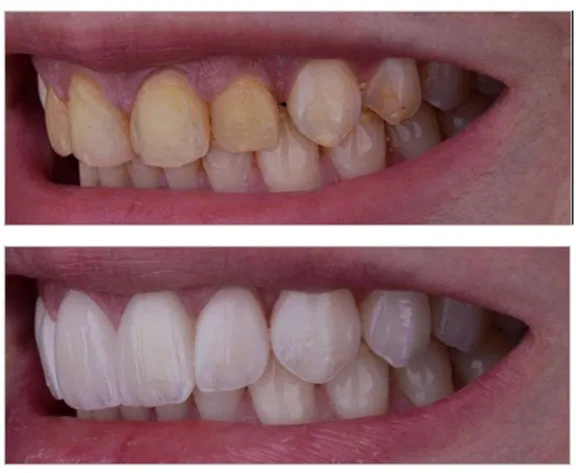 Como mejorar nuestra estética bucal con Carillas Dentales